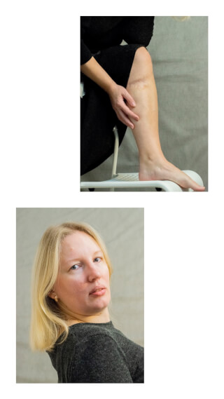 A woman shows her leg and a scar in a medium shot indoors.